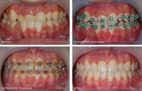 How Do Braces Move Your Teeth Teethwalls