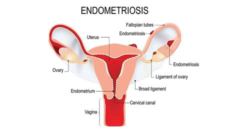 Treatment of endometriosis and chronic pelvic pain with letrozole and norethindrone acetate: Endometriosis: The 4 Stages & Treatment Options - Medicine.com