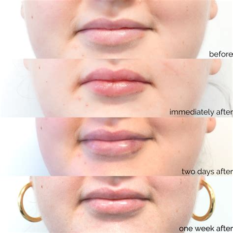 The Lip Filler Journey 👄 You Will Experience The Most Swelling And Some Bruising The Day After
