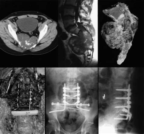 Surgical Approaches For The Resection Of Sacral Tumors Neupsy Key