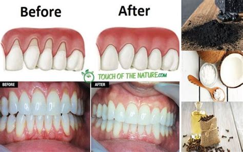 Once you decide to get braces, keep in mind that these will be the results: How Long Does It Take To Get Rid Of Braces - Hulya Alagoz