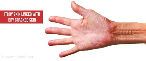 Itchy Skin Pruritus Causes Symptoms Diagnosis Treatment