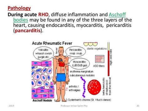 Rheumatic Fever Rhd And Infective Endocarditis