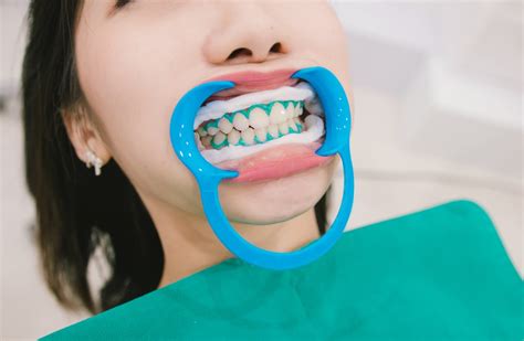 Ultimate Guide On Teeth Whitening Sutton Place Dental Associates