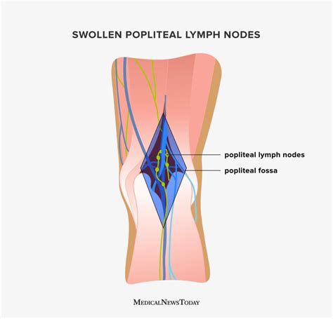 Swollen Popliteal Lymph Nodes Causes Anatomy And Diagnosis