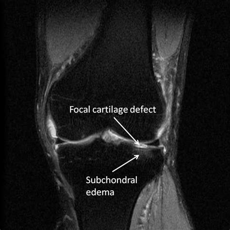 Left Knee T2 Weighted Coronal Magnetic Resonance Imaging Accentuates