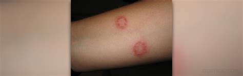Circular Red Rash Skin And Hair Problems Articles Body And Health
