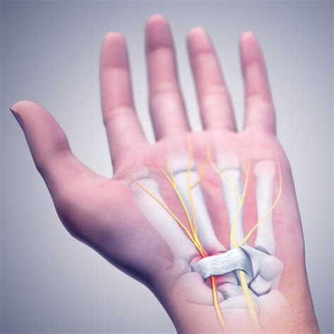 How To Treat Carpal Tunnel Syndrome Without Surgery Tanya Coats