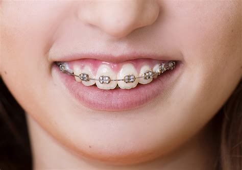 Perfect Braces Colors For Girls Teeth Beauty And Health Facts