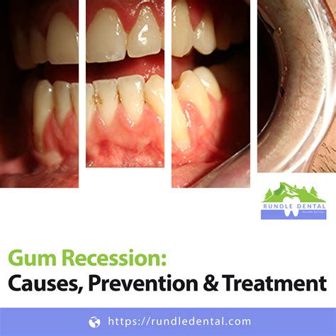 Gum Recession Causes Prevention Treatment Rundle Dental Blog