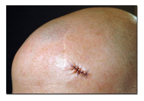 Basal cell carcinomas (bcc's)of the skin do not metastasize to lymph nodes or through the bloodstream, but will yes, basal cell carcinomas can be cured in almost every case, although treatment becomes complicated if they. Basal cell carcinoma | I've had a number of moles removed ...