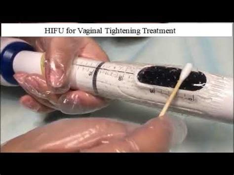 Hifu Vaginal Tightening Treatment Youtube