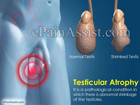 Testicular Atrophytreatmentcausessymptomspreventiondiagnosis