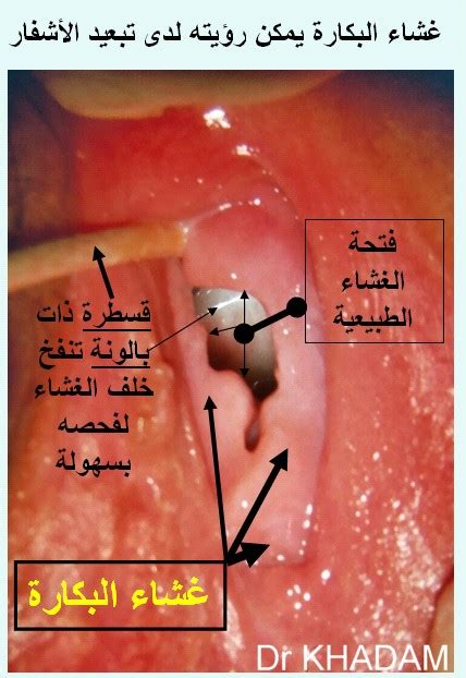 طبيب الوب نصائح صحية اسئلة و اجوبة و كل شيء عن البكارة L Hymen دكتور لؤي خدام