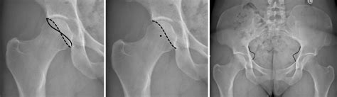 Radiographic Signs Of Acetabular Retroversion In Ap Projections With