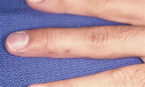Trauma: Percutaneous Pin Stabilization with Thermoplastic ...