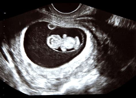 Bebe 9 Semanas Ultrassom