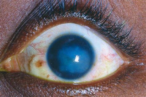 Cornea Review Questions In Ophthalmology