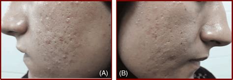 A Case Of 25 Years Old Female With Grade 3 Atrophic Acne Scar Icepick