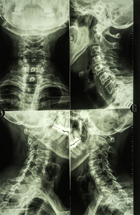 Diagnostic Neck X Rays Photograph By Brian Gadsbyscience Photo Library