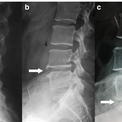 Assesment Of The X Ray Features Of Lumbar Disc Degeneration Lateral