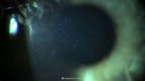 Map Dot Fingerprint Dystrophie SPL Male OD 20220426 03 