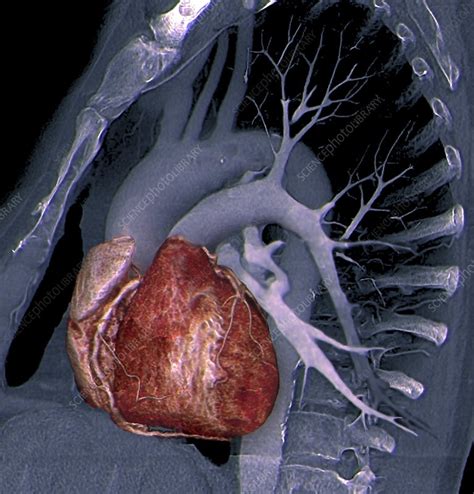 Healthy Heart 3d Ct Scan Stock Image C0133046 Science Photo Library