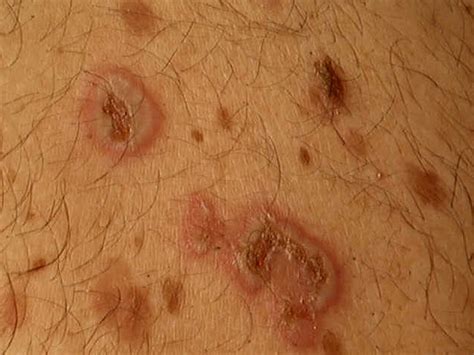 Pemphigus Vulgaris Pictures Symptoms Causes Diagnosis Treatment