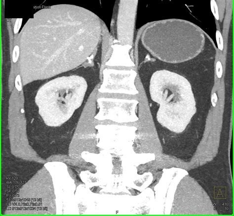 Calcified Adrenal Glands Due To Prior Tb Adrenal Case Studies