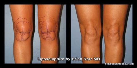 Knees Liposuction Exposed Mommy Makeover Surgery Liposuction Skin