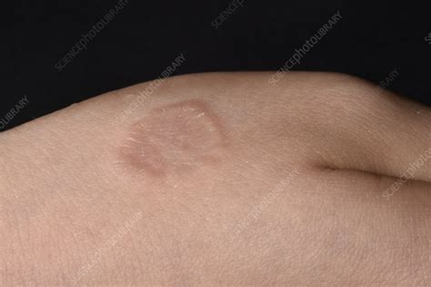 Skin Lesion Stock Image C0498658 Science Photo Library