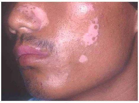 It is the topic that still baffles the. pityriasis alba | Medical Pictures Info - Health ...