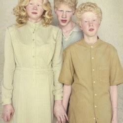 Albinizm Co To Jest Jakie S Przyczyny Albinizmu Jak