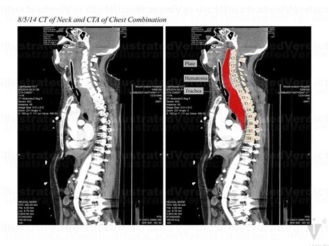 Case At A Glance Cervical Spine Fusion Post Op Hematoma