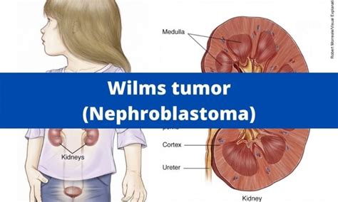 Wilms Tumor Nephroblastoma Medical Junction