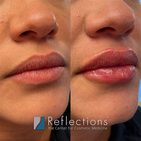 Best Restylane Kysse Specials Near Me Nj Lip Injection Price Cost