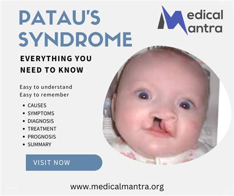 Pataus Syndrome Trisomy 13 Causes Symptoms Diagnosis Treatment
