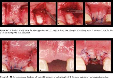 Associated findings include lower extremity varicosities, edema, venous dermatitis, and lipodermatosclerosis. Achieving Soft Tissue Closure in Immediate Implant Therapy ...