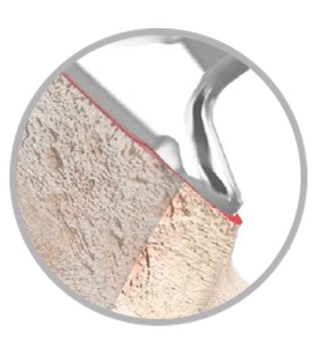 Actis® Total Hip System Depuy Synthes