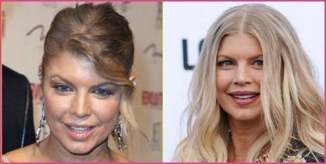 Fergie Plastic Surgery Before And After Celebrity Plastic Surgery