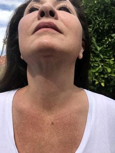 Lower Facelift Scars Under Chin 1 Facelift Info Prices Photos