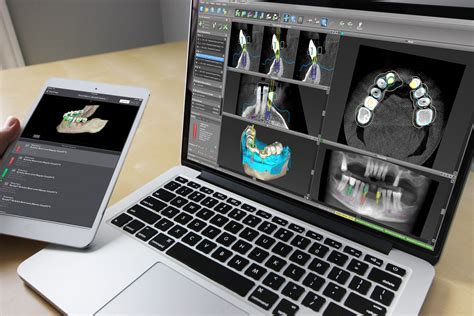 Nuevo Software 3d Planificación Implantes Dentales