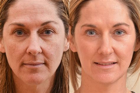 What Can Different Types Of Facial Wrinkles Tell Us Biomechanics In