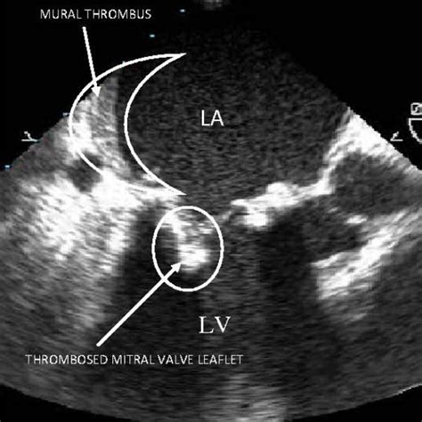 Pdf Bioprosthetic Mitral Valve Thrombosis Less Than One Year After