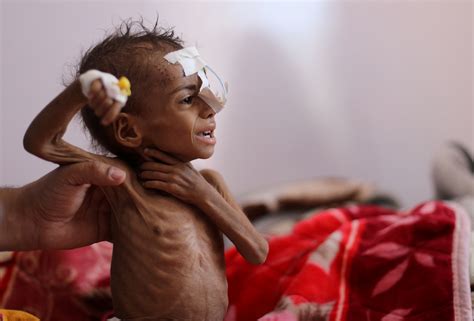 At Least 400000 Yemeni Children Under 5 Could Die Of Starvation This