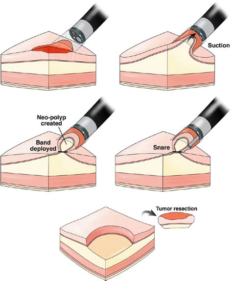 Endoscopic Mucosal Resection Emr Abdominal Key