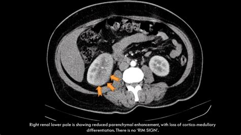 Ultimate Radiology Case Of Bilateral Pyelonephritis