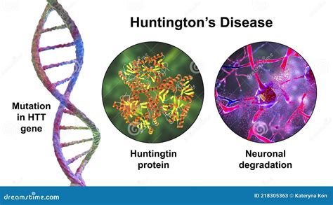 Huntington S Disease A Neurodegenerative Disease Due To Mutation In