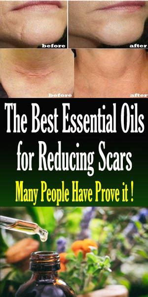 The Best Essential Oils For Reducing Scars