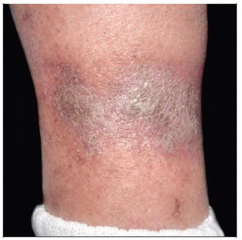 Stasis Dermatitis Histology